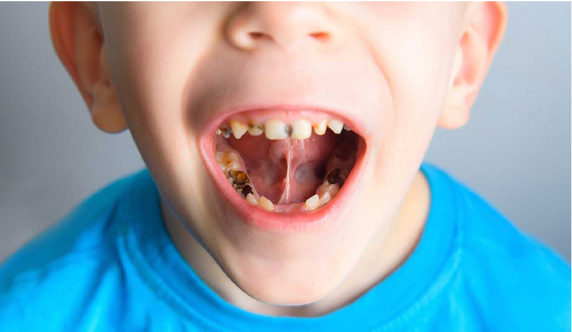 niño con caries